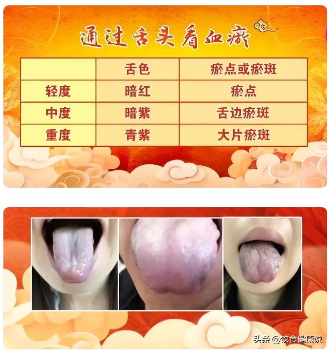 痰湿血瘀健脾利湿_中医血瘀体质辨识_血瘀体质舌象识别