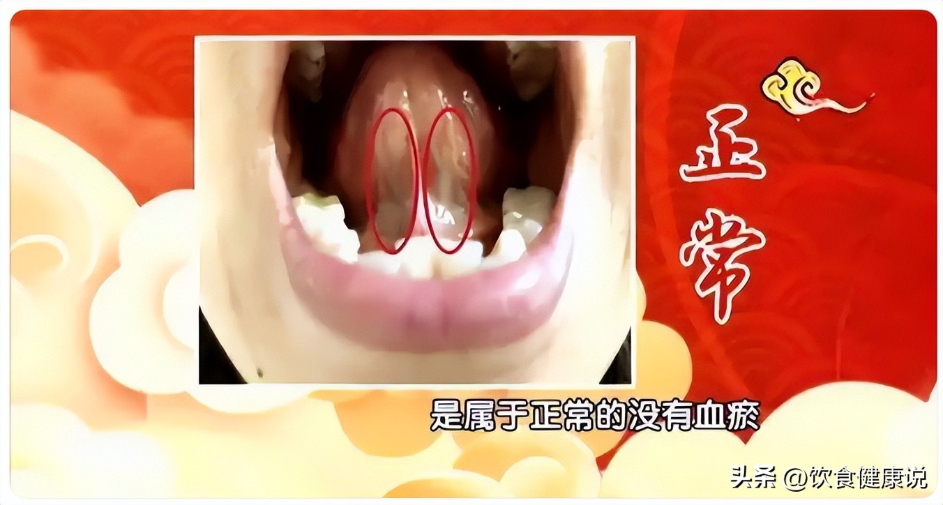 中医血瘀体质辨识_血瘀体质舌象识别_痰湿血瘀健脾利湿