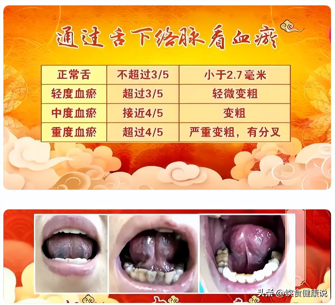 中医血瘀体质辨识_痰湿血瘀健脾利湿_血瘀体质舌象识别
