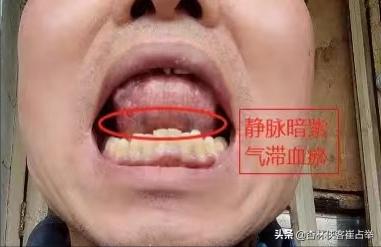 中医血瘀体质辨识_舌象判断淤血原因_淤血体质调理