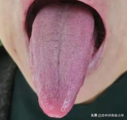 淤血体质调理_中医血瘀体质辨识_舌象判断淤血原因