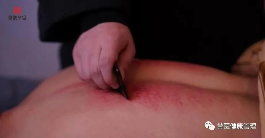 中医刮痧抗过敏_春季过敏刮痧艾灸_中医治疗过敏方法