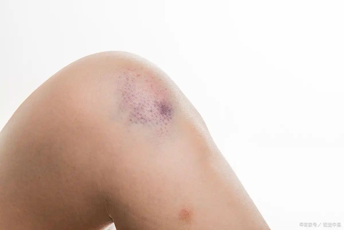 调理血瘀体质最有效的_血瘀危害_血瘀体质形成原因