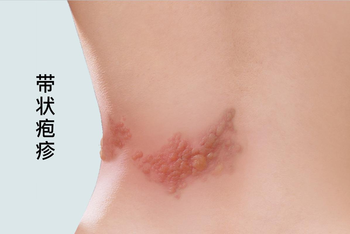 带状疱疹后神经痛预防_带状疱疹患者饮食禁忌_带状疱疹并发症