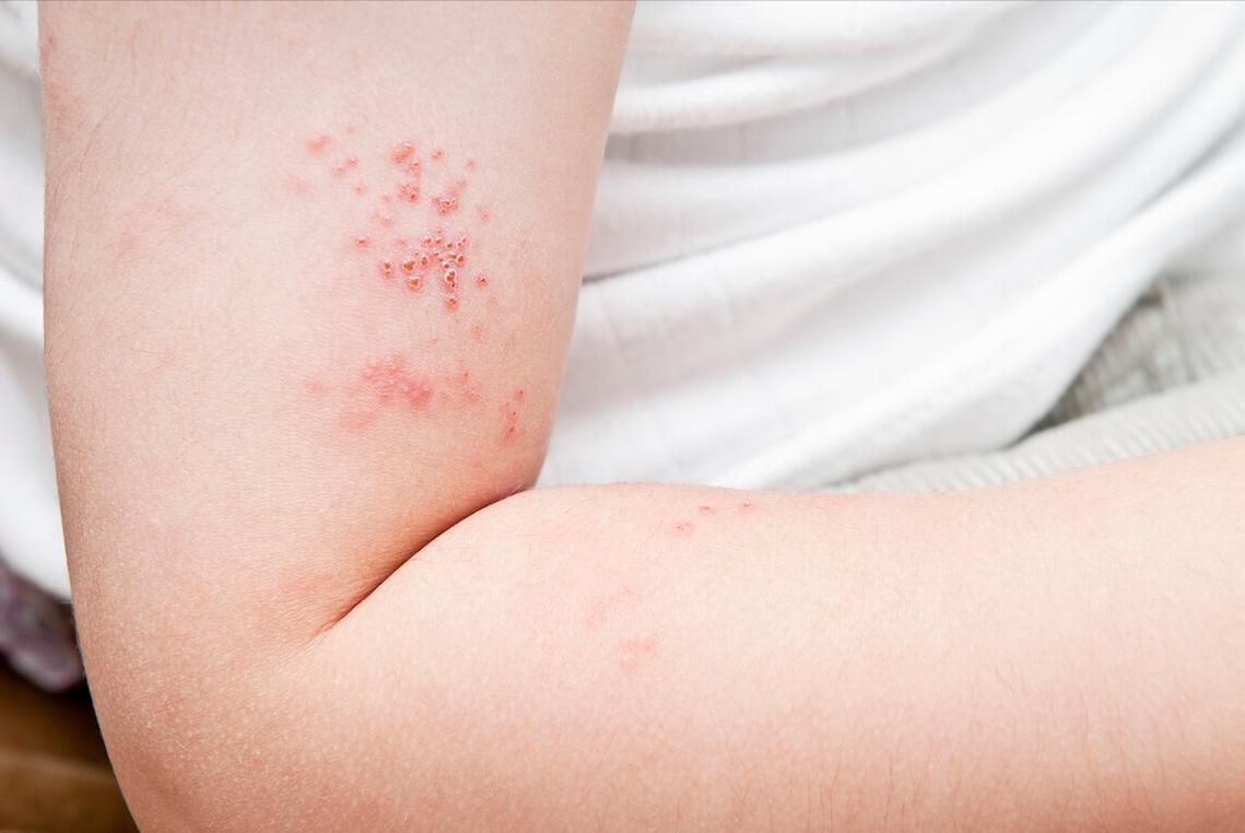 带状疱疹后神经痛预防_带状疱疹患者饮食禁忌_带状疱疹并发症