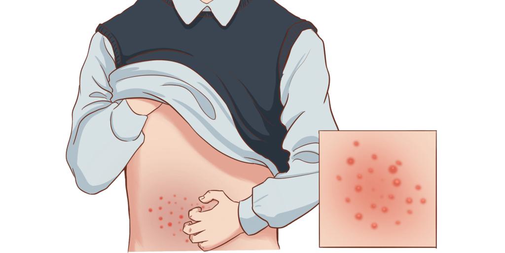 带状疱疹后遗神经痛治疗_带状疱疹重症预防_带状疱疹患者饮食禁忌