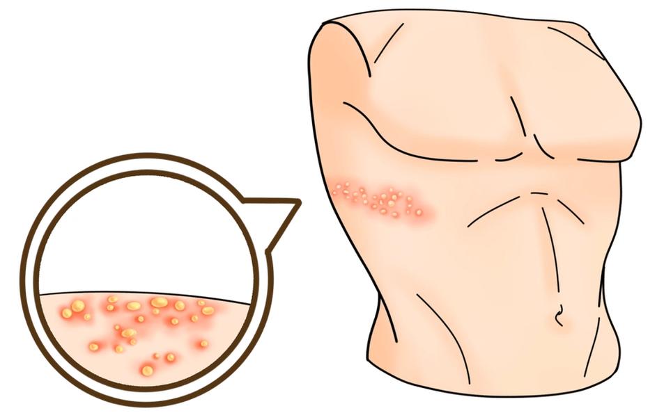 带状疱疹后遗神经痛治疗_带状疱疹重症预防_带状疱疹患者饮食禁忌