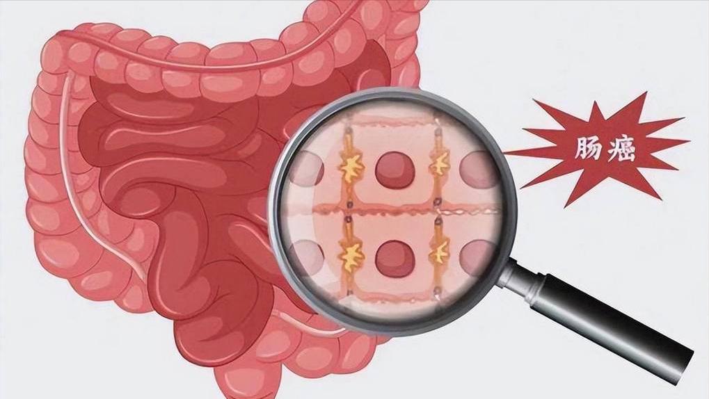 便秘食疗 白萝卜黑木耳组合 改善肠道蠕动_女性便秘的治疗偏方