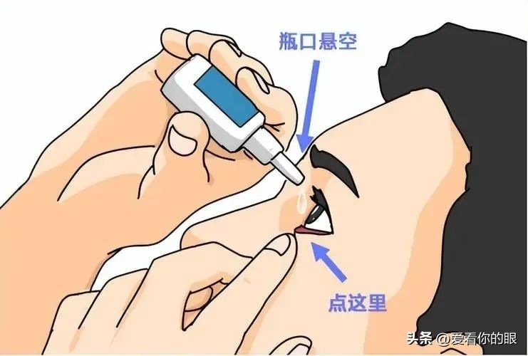 白内障手术术后用药_白内障手术后注意事项_白内障术后饮食禁忌