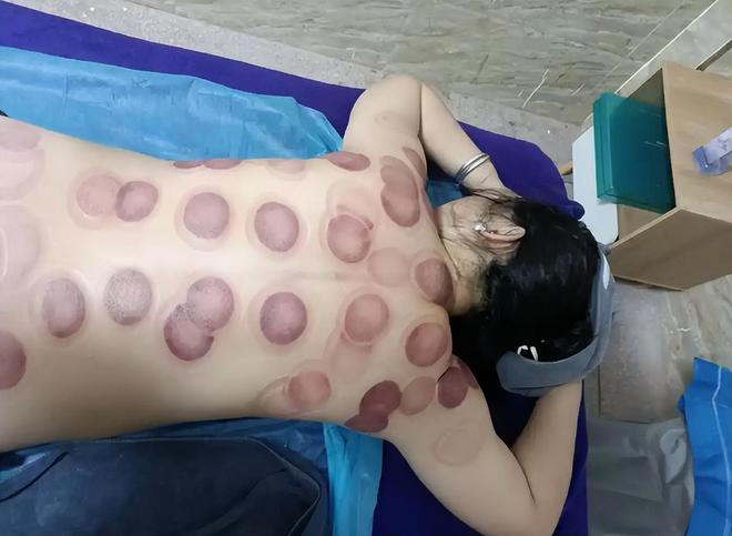 中医拔罐_拔火罐瘀血印记_拔火罐排毒误区