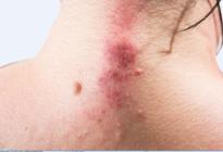 居家刮痧疗法_中医刮痧板_刮痧板使用方法