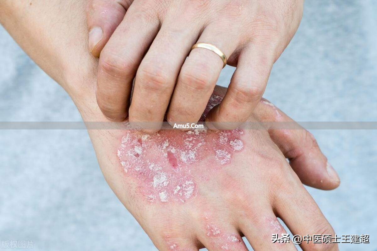 脾胃亏虚荨麻疹症状_荨麻疹反复发作中医治疗_中医古法养生改善荨麻疹