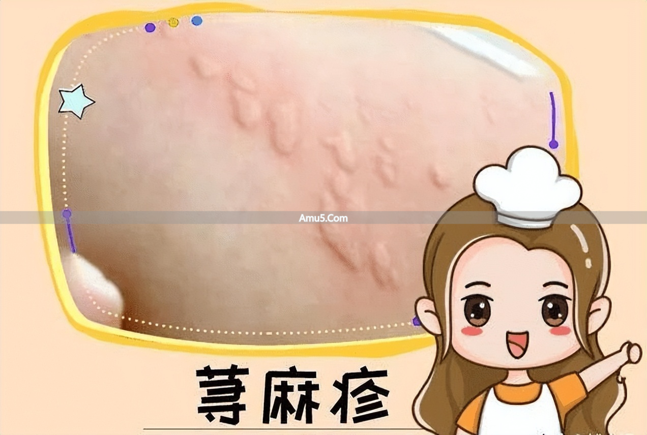 慢性荨麻疹中医治疗_荨麻疹中医辨证施治_中医古法养生改善荨麻疹