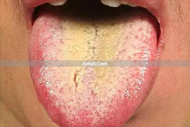 湿热肝郁_中医湿热体质调理中成药_肝郁化火脾虚