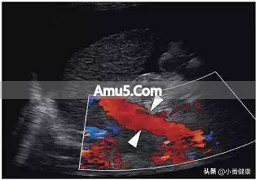 乙肝大三阳饮食禁忌_乙肝大三阳熬夜影响_乙肝大三阳如何保护肝脏