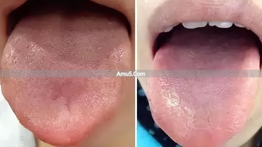 舌苔辨识体质方法 _ 中医体质调理春季方案 _ 中医九种体质辨识
