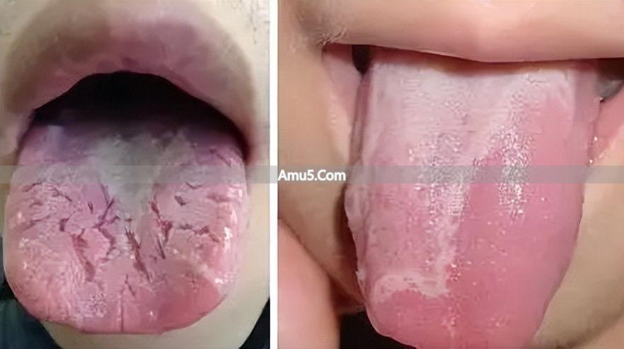 中医体质调理春季方案 _ 舌苔辨识体质方法 _ 中医九种体质辨识