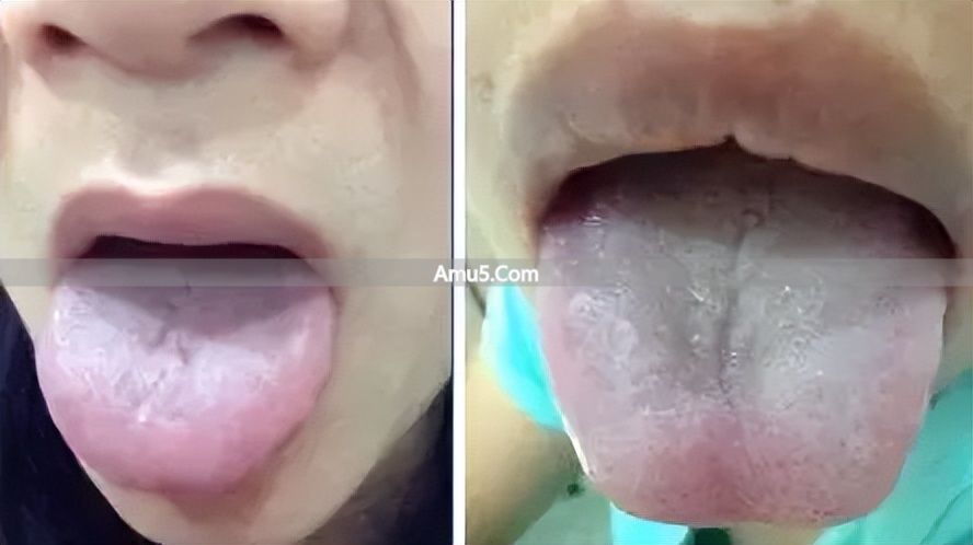舌苔辨识体质方法 _ 中医九种体质辨识 _ 中医体质调理春季方案