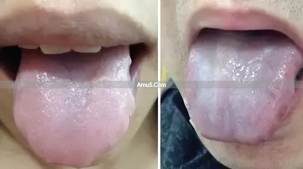 舌苔辨识体质方法 _ 中医九种体质辨识 _ 中医体质调理春季方案