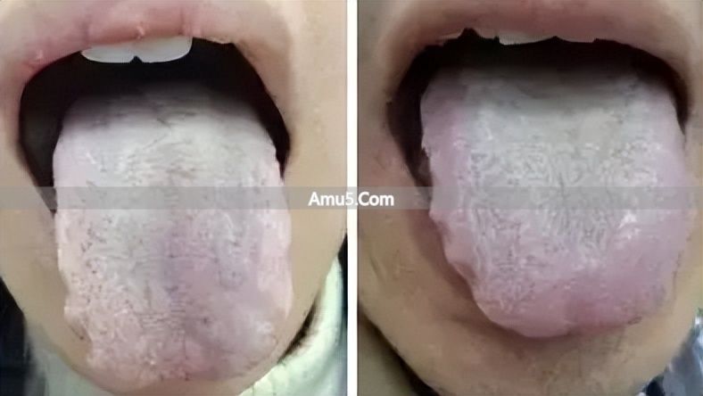 舌苔辨识体质方法 _ 中医体质调理春季方案 _ 中医九种体质辨识