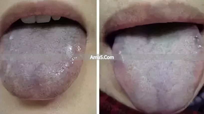 舌苔辨识体质方法 _ 中医九种体质辨识 _ 中医体质调理春季方案